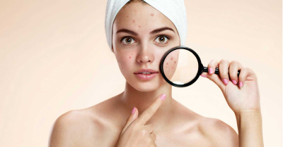 11 razões que podem explicar por que você não consegue se livrar da acne